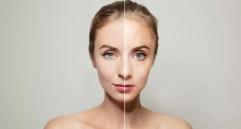 Peau Granuleuse : Comment Dire Adieu aux Aspérités ?