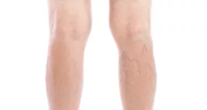 Le café et les varices : Ami ou ennemi ?