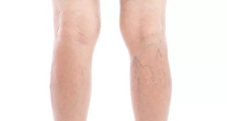 Le café et les varices : Ami ou ennemi ?