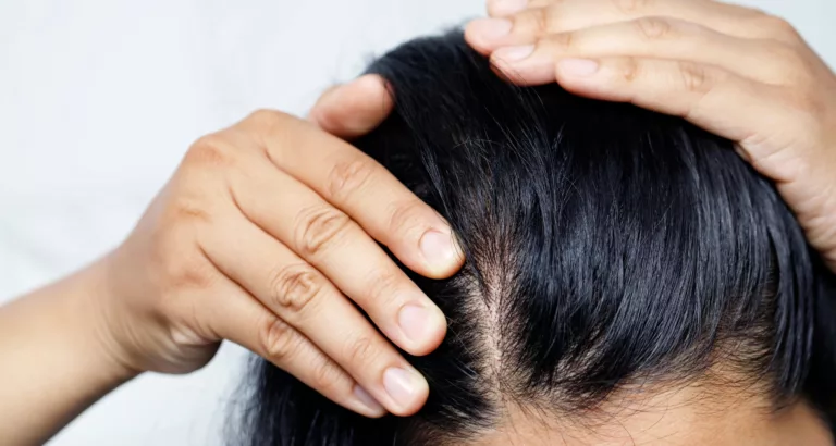 Bouton cuir chevelu : Ce que ça peut être et comment y remédier